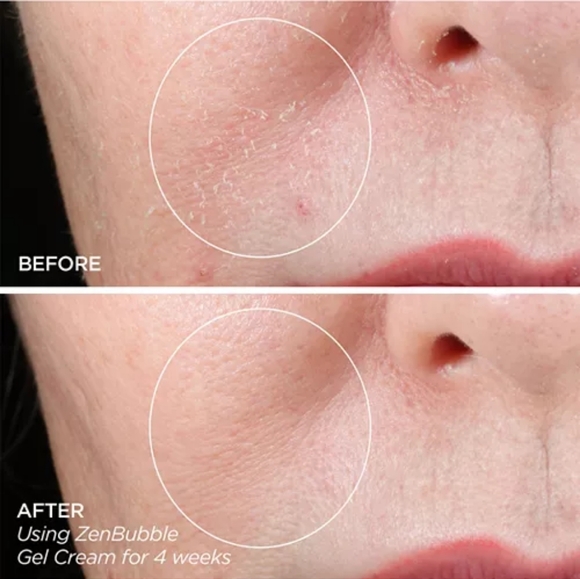 Beauty Bio Microneedle, Zen Bubble Moisturizer, & The Balance Cleanser Set - Picture 9 of 15